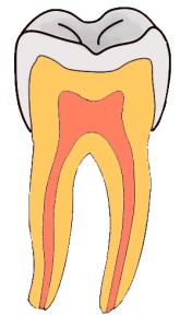 Pit-and-Fissure-Caries-GIF